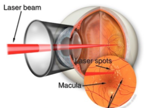 focal laser photocoagulation