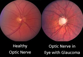 abnormal-optic-nerve