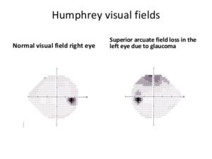 visual-field-loss